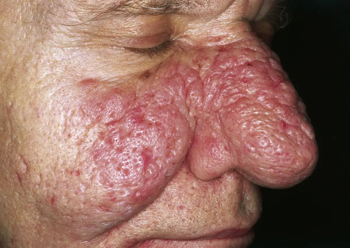 Thickened skin over the nose from advanced phymatous rosacea