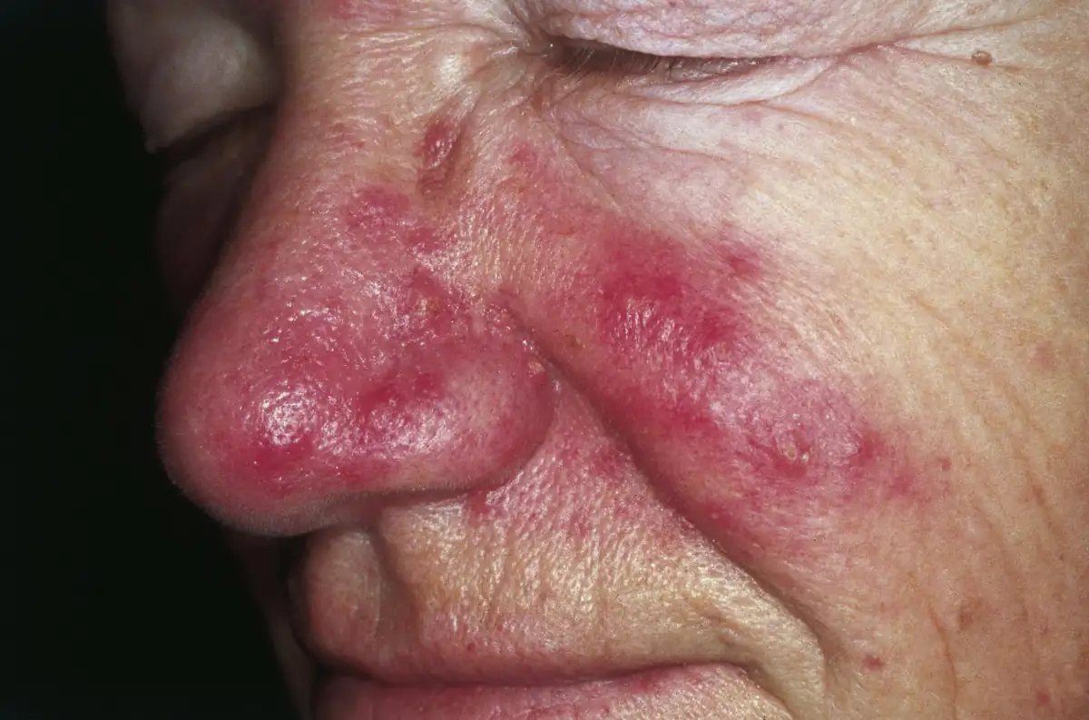 Facial redness and visible blood vessels across the cheeks and nose in rosacea