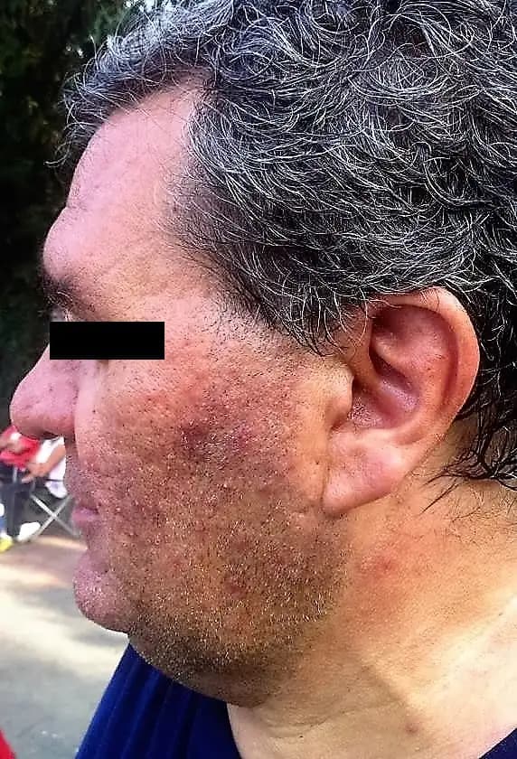 Papules and pustules on the face during a rosacea flare