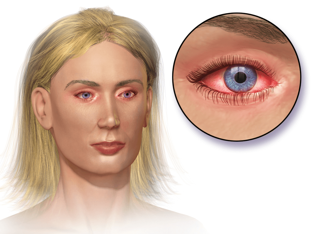 Medical illustration of allergic conjunctivitis showing redness across both eyes and a magnified red eye