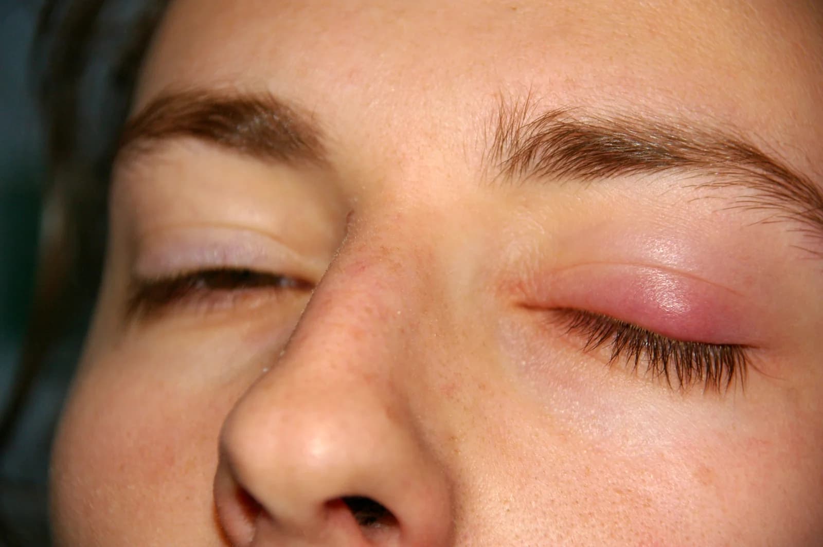 Close-up of a person with eyes closed, showing localized redness and swelling of one upper eyelid
