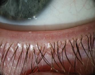 Close-up of a lower eyelid pulled down, showing the eyelashes and tiny openings of the meibomian oil glands along the eyelid margin