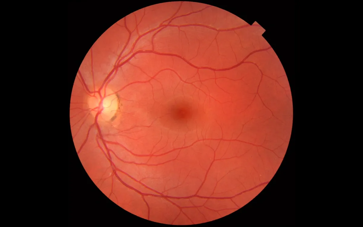 Photograph of a healthy retina showing the optic disc, macula and blood vessels